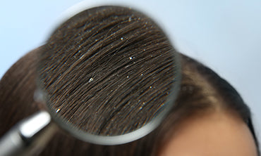 Engross the power of Ayurveda into your daily Hair Care Regime to treat Dandruff